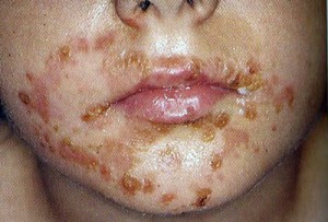 Aus: Chinesische Medizin bei Hautkrankheiten von A. Stöger