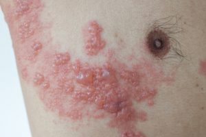 herpes_zoster